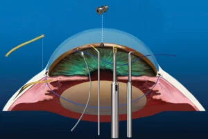 Are we reaching a tipping point of combined cataract and glaucoma surgery?